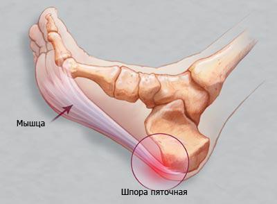 Пяточная шпора: особенности и лечение